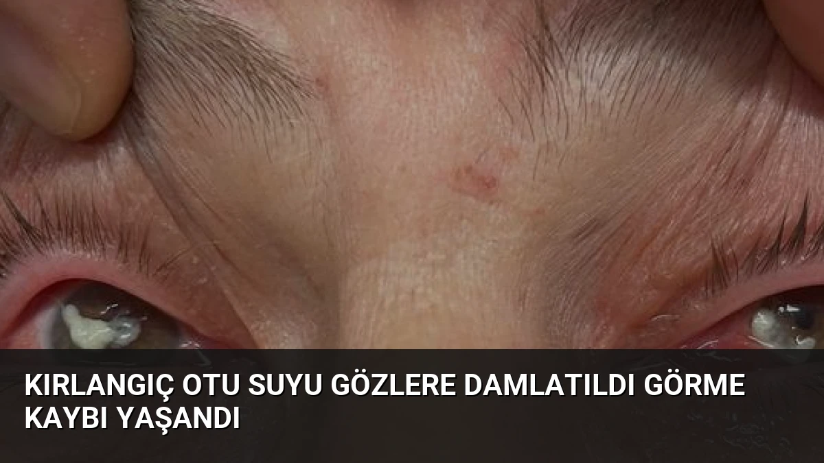 Kırlangıç Otu Suyu Gözlere Damlatıldı Görme Kaybı Yaşandı